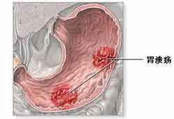 胃溃疡常见病因