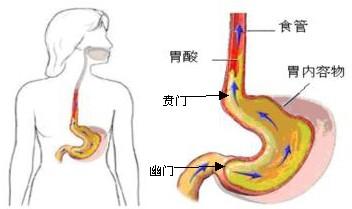 胆汁反流性胃炎诊断