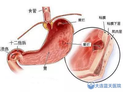 大连广誉远胃病医院告诉您，慢性胃病的病理危害有哪些？